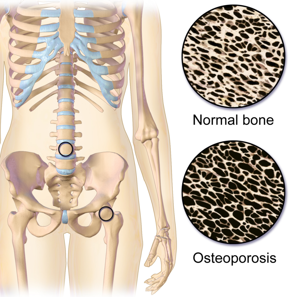 Coconut Oil Good for Osteoporosis Prevention.