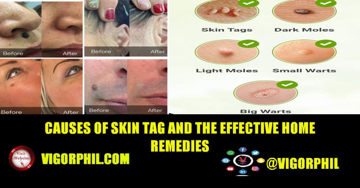 Causes Of Skin Tag
