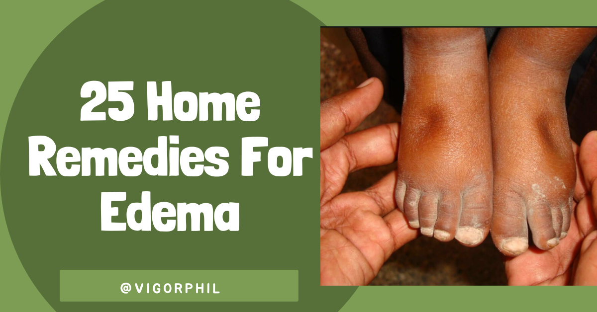 25 Home Remedies For Edema