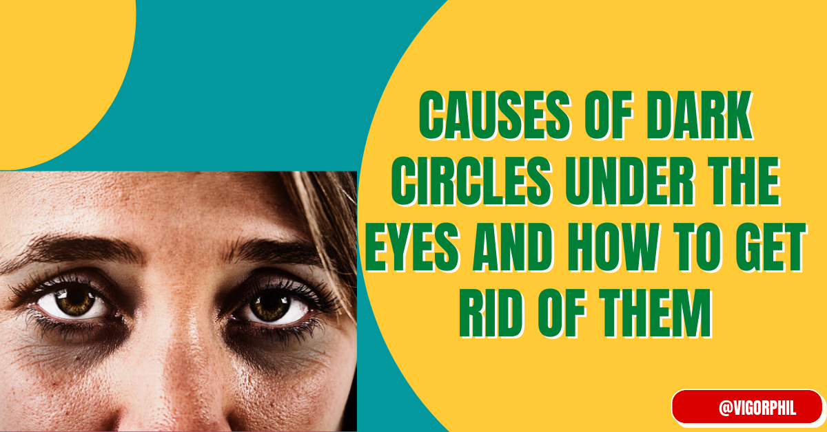 causes dark circles under the eyes and how to get rid of them