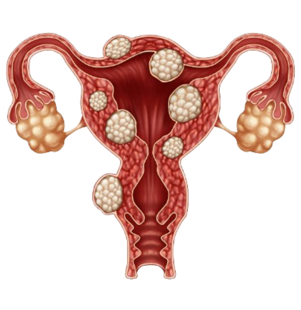 NATURAL REMEDIES FOR FIBROID