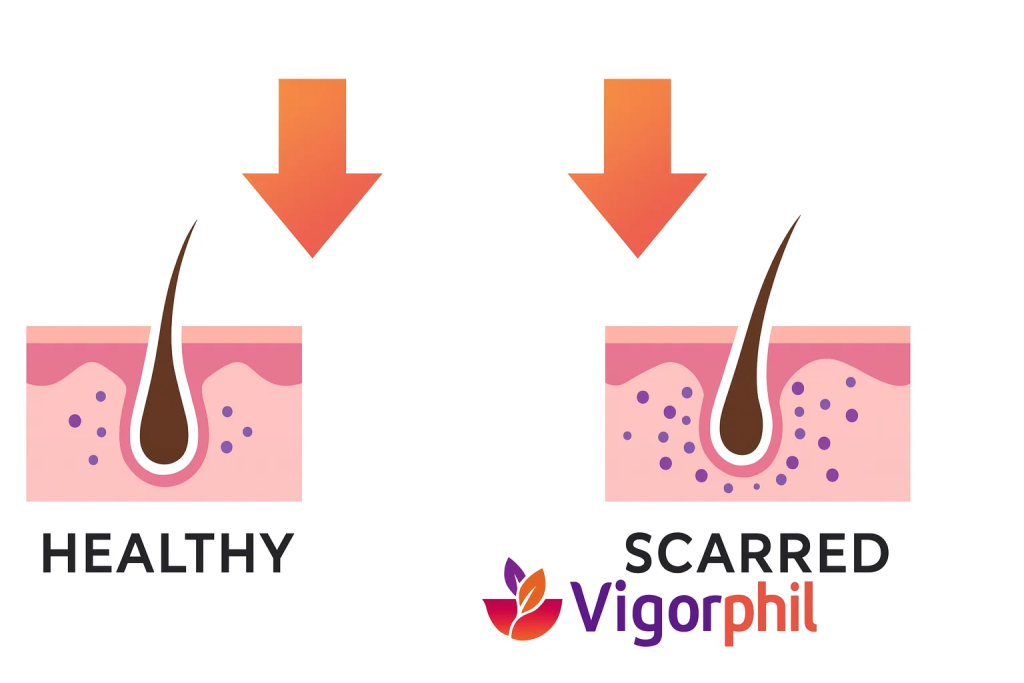 Healthy hair follicle vs. DHT-damaged follicle showing scar tissue formation and reduced oxygen flow